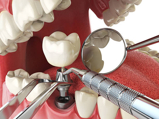 Best Chipped Tooth Repair Near Me  in Green Tree, PA